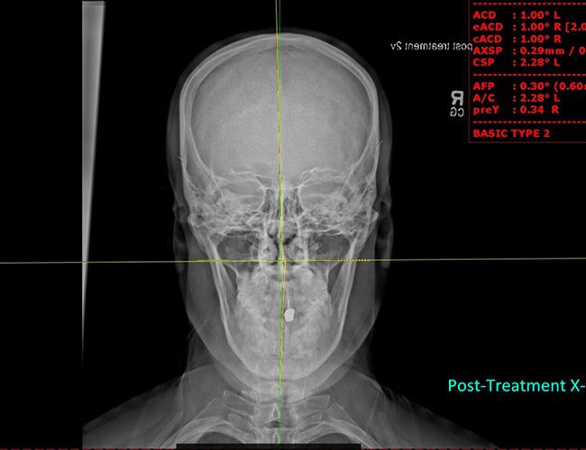 Trappe PA chiropractor post-treatment x-rays