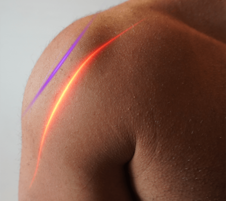 shoulder pain laser